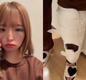 츠바키 리카, 귀가 중 교통사고 당해.. 얼굴과 다리가 많이 부은 상태